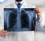 בדיקות גנומיות: כיצד הן יכולות להאריך את חייהם של חולי סרטן הריאה?       -תמונה